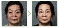 face-lifting.jpg
